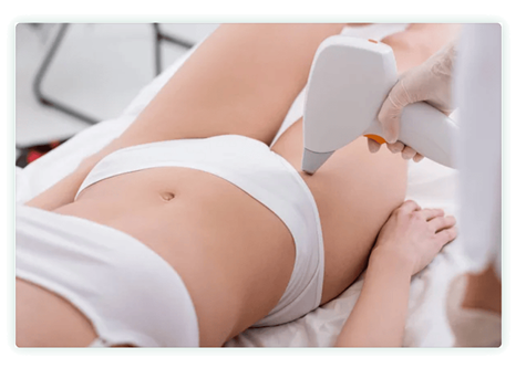 Haarentfernung Bikinizone / Intimzone